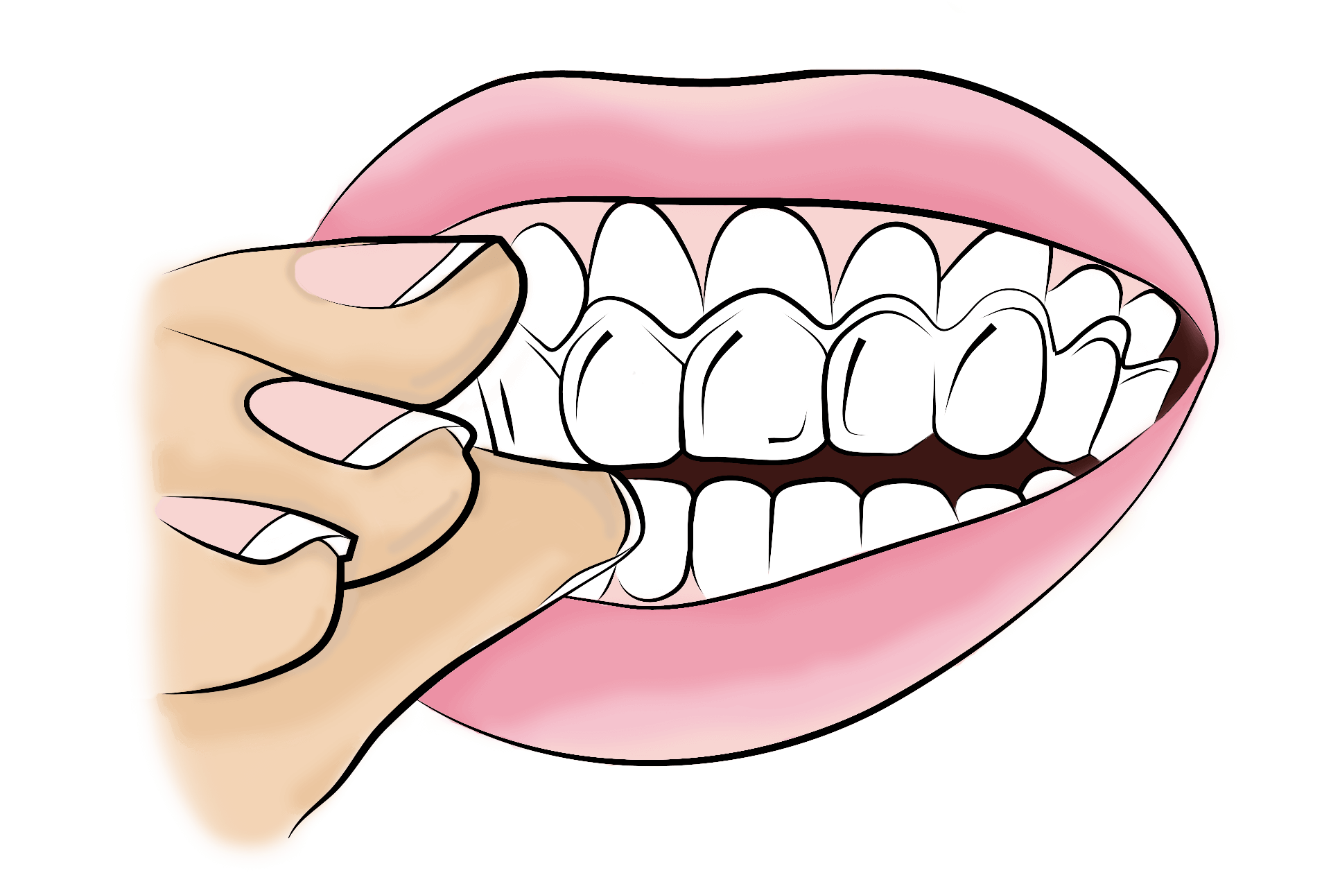 Aligner insertion